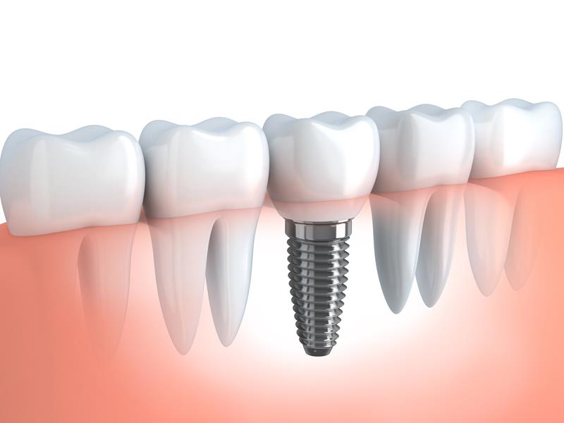 Dental Implants Kirkland, WA 